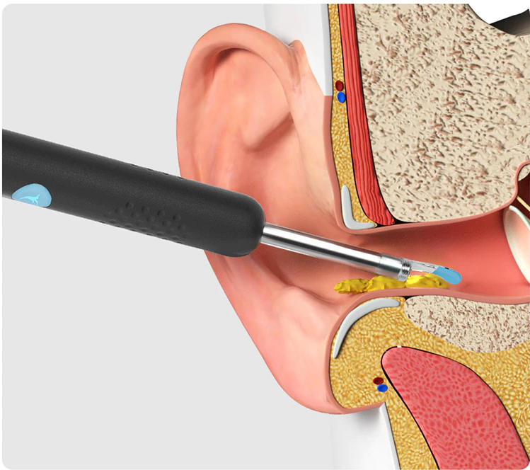 Endoscopic Ear Cleaner